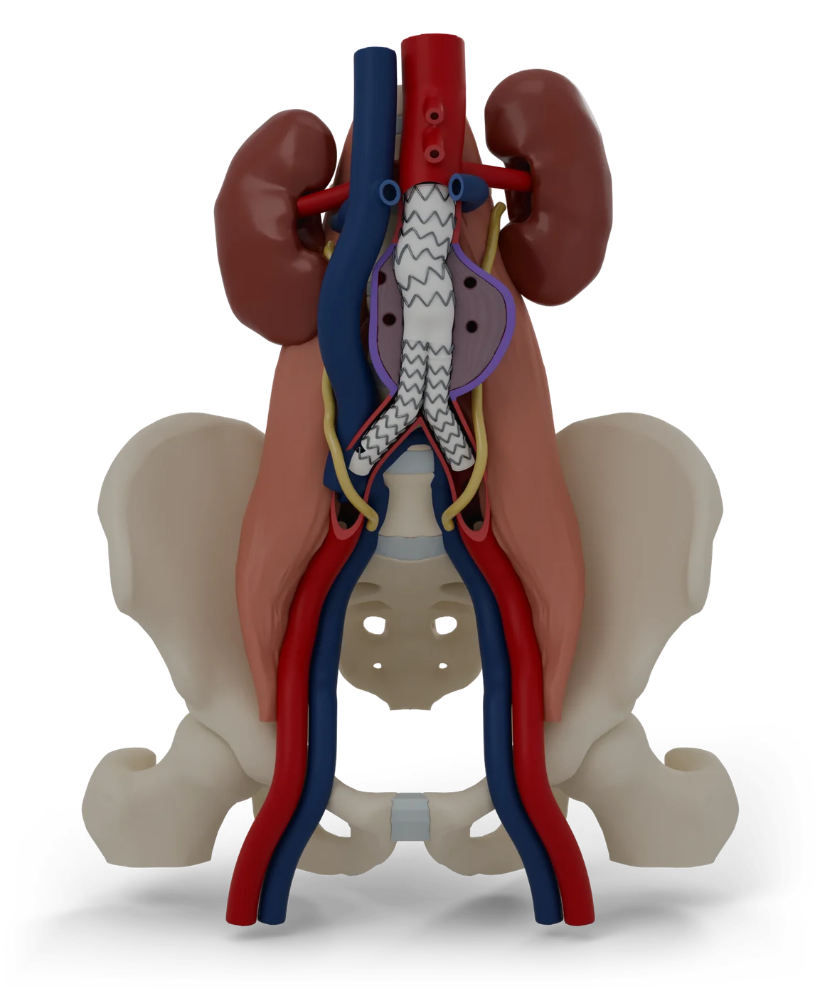 Endovascular aneurysm repair model, after treatment.
