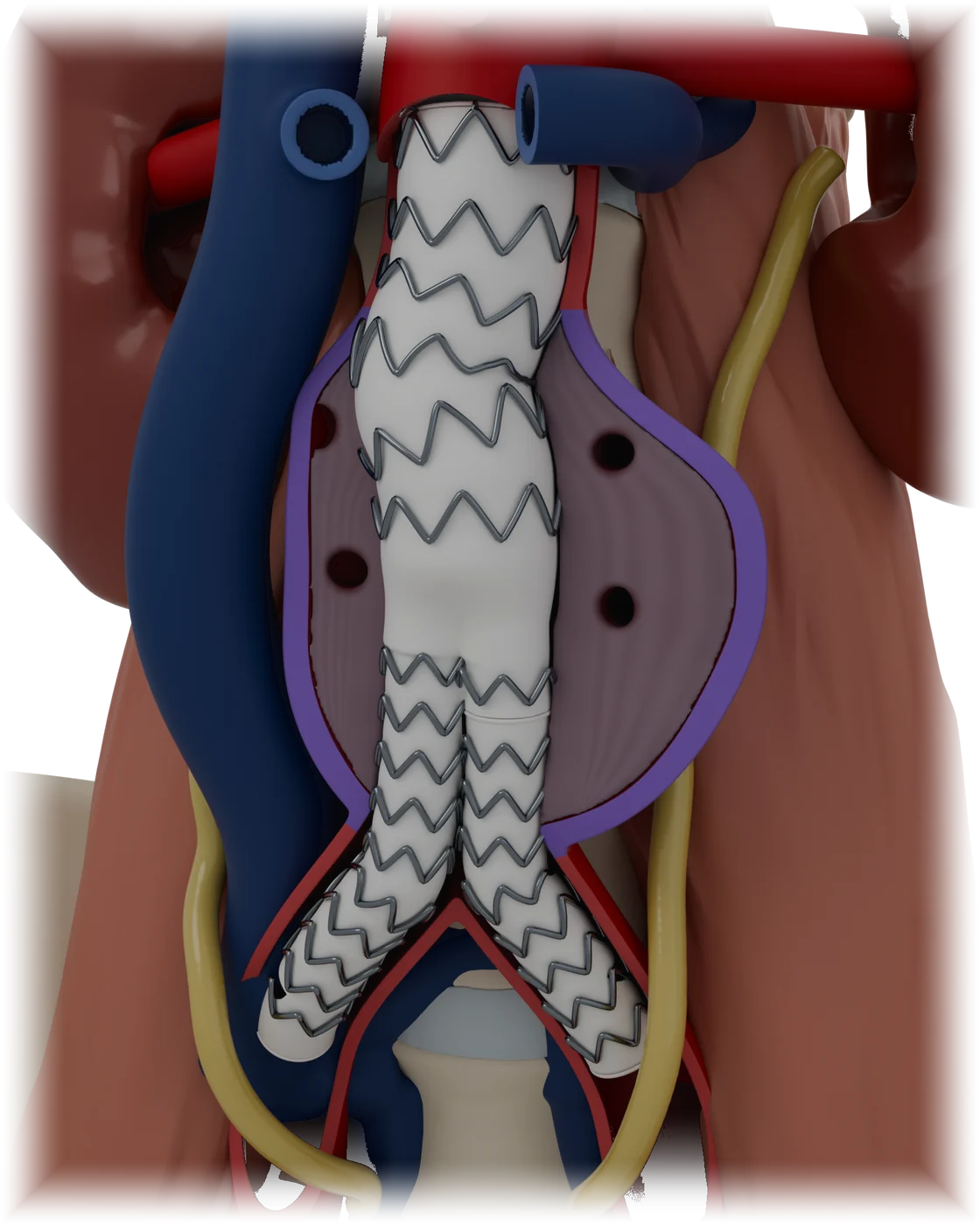 Endovascular aneurysm repair model, detail view.