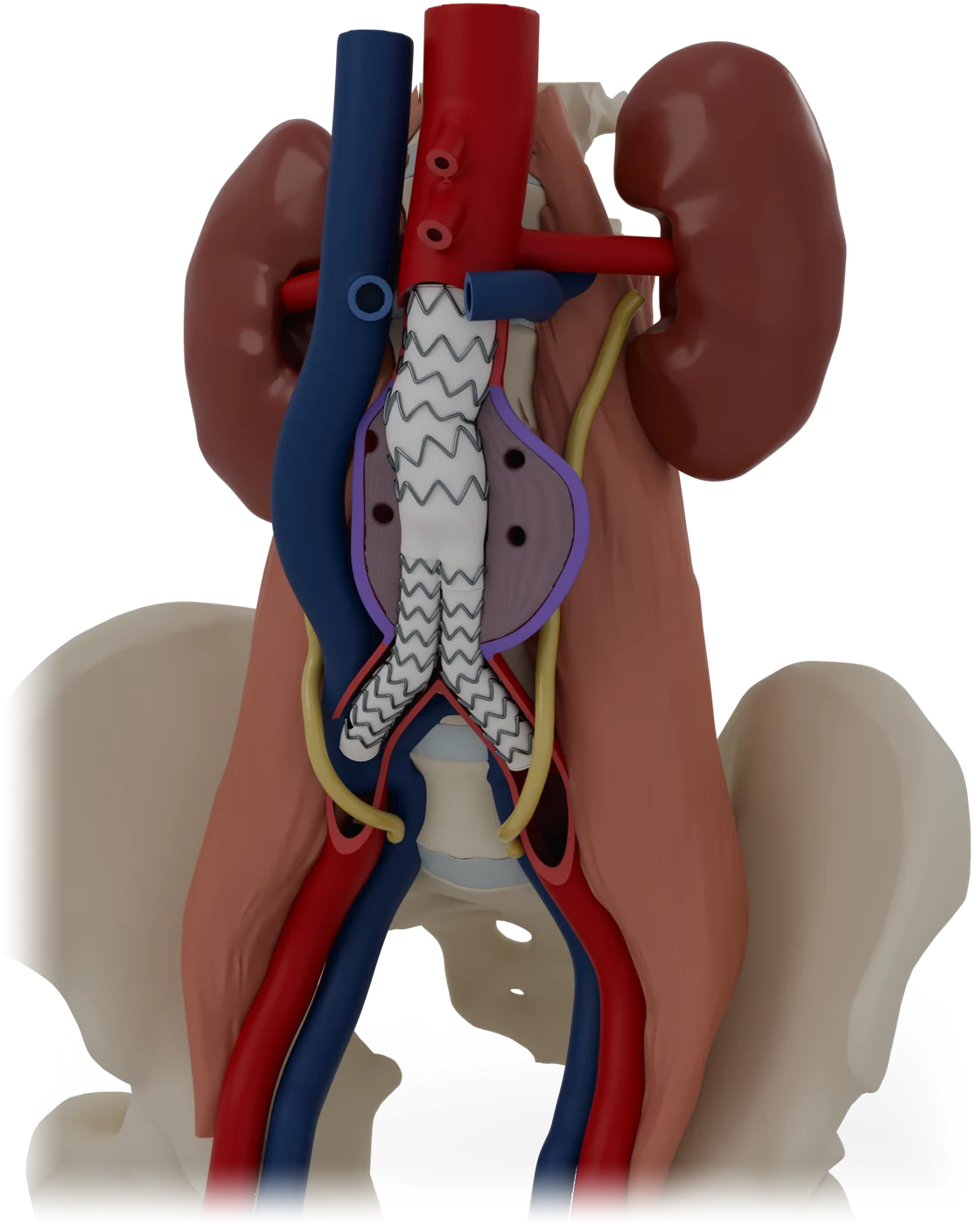 Endovascular aneurysm repair model, hero view.