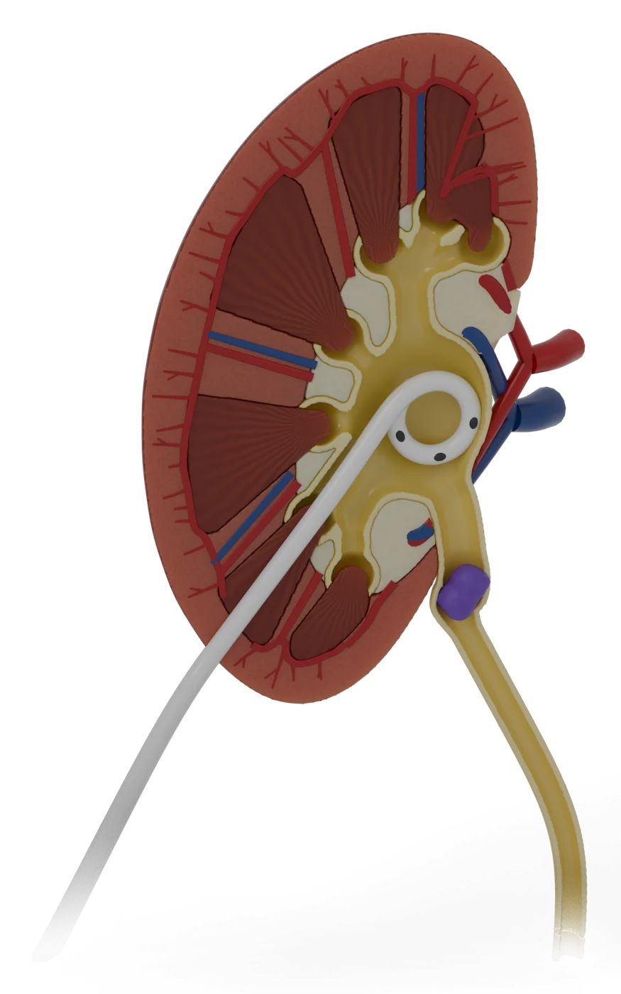 Nephrostomy tube model, after treatment.