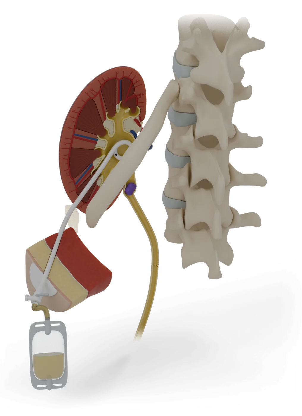 Nephrostomy tube model, front view.