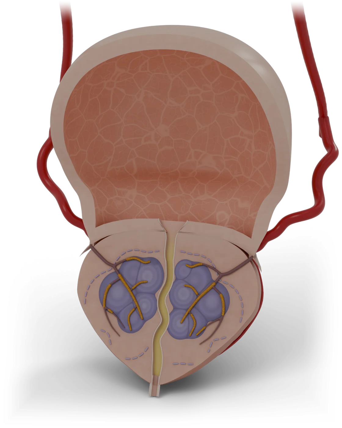 Prostate artery embolization model, after treatment.