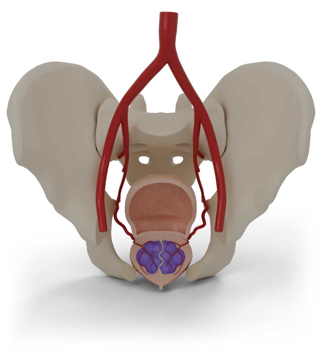 Prostate artery embolization model, front view.