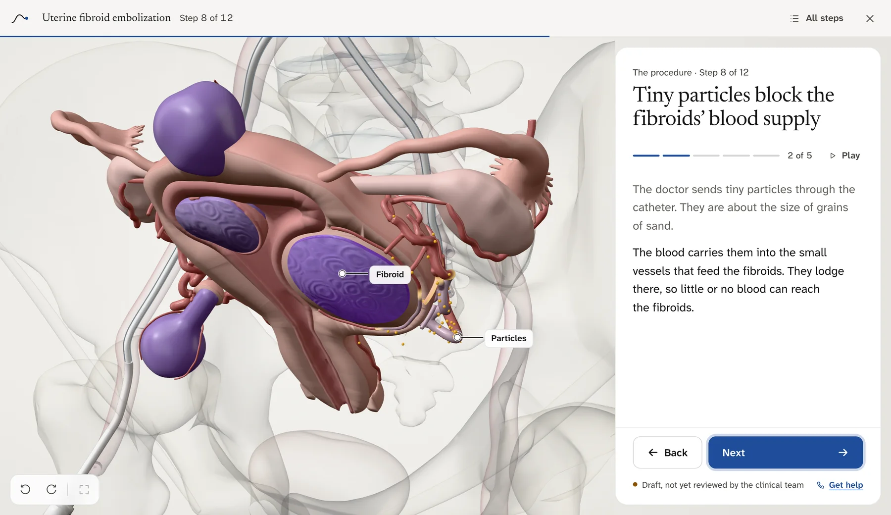 The step-by-step guide for Uterine fibroid embolization: the 3D model on the left with its parts labelled, the step’s explanation on the right.
