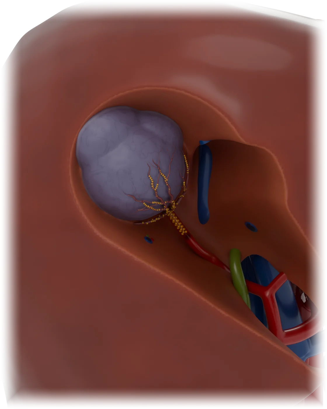 Chemoembolization of the liver model, after treatment.