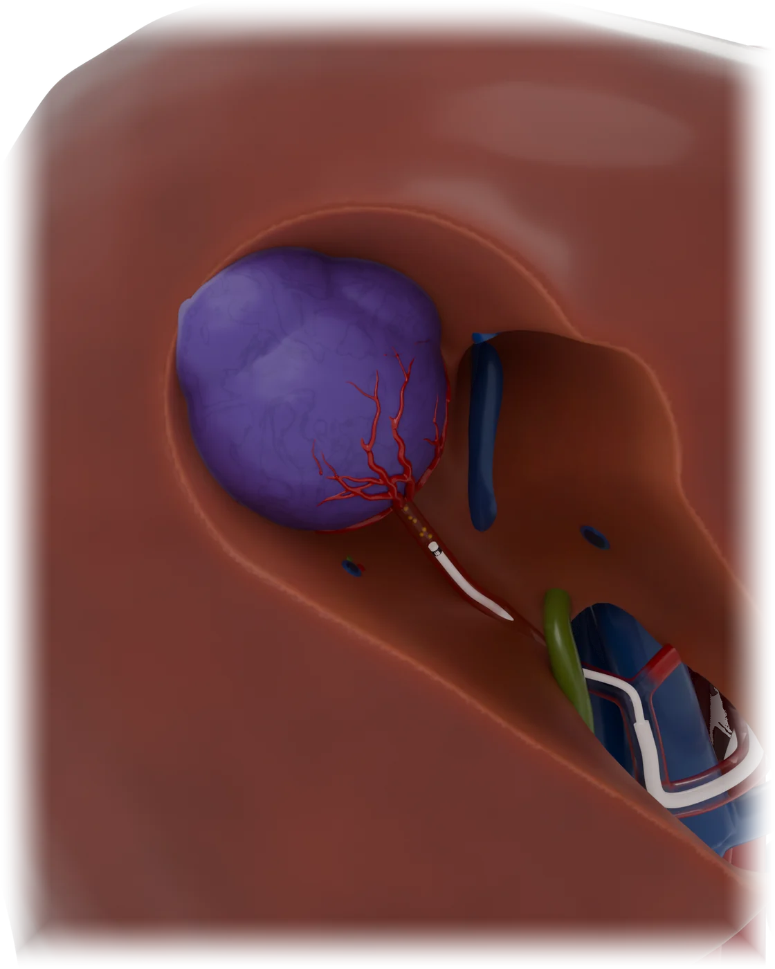 Chemoembolization of the liver model, detail view.