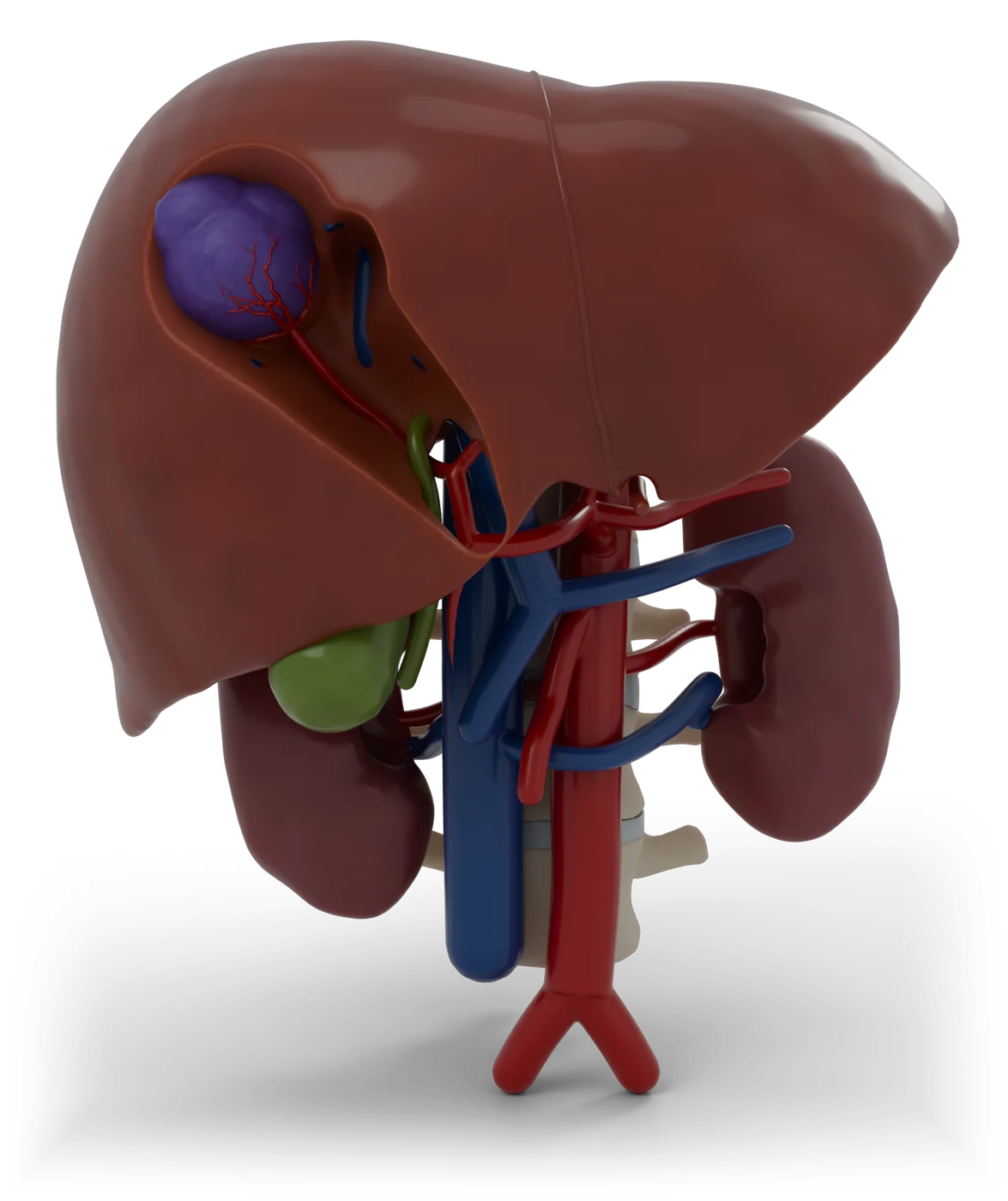 Chemoembolization of the liver model, front view.