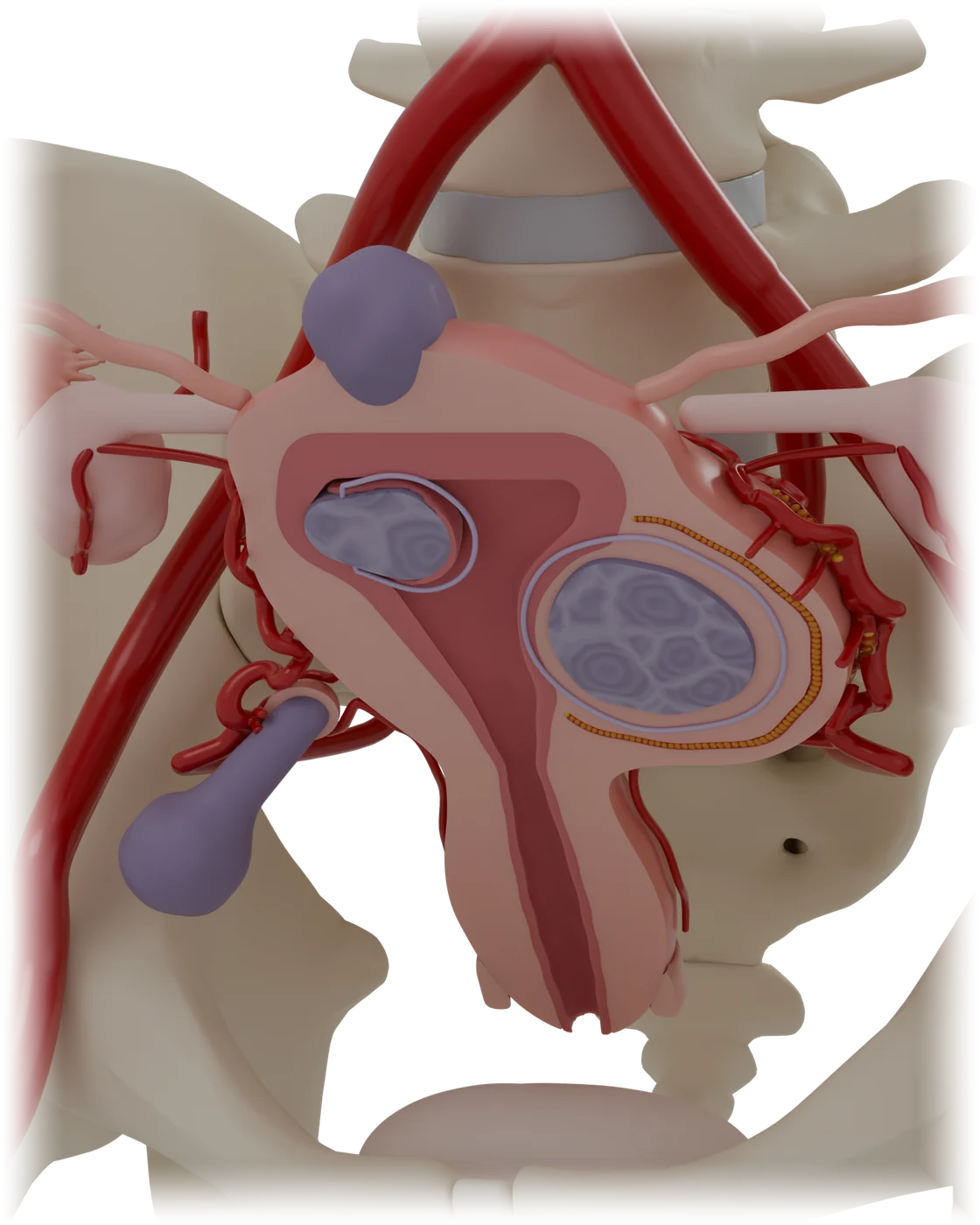 Uterine fibroid embolization model, after treatment.