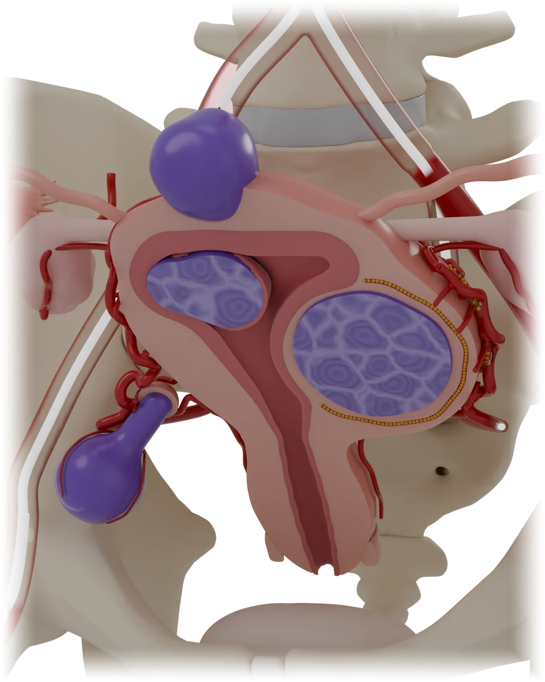 Uterine fibroid embolization model, detail view.