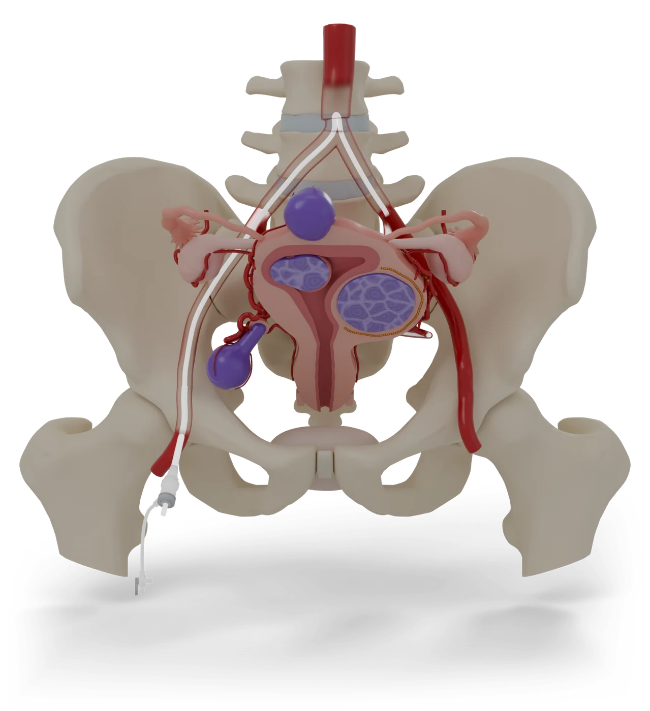 Uterine fibroid embolization model, front view.