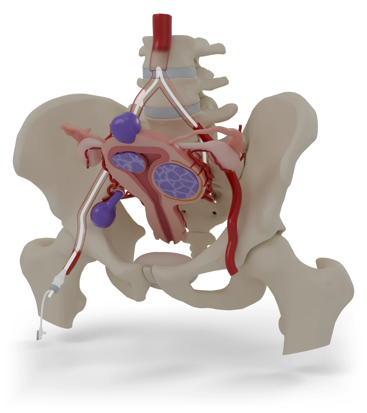 A model of the uterus, cut open. Purple: fibroids. Red: the arteries that feed them.