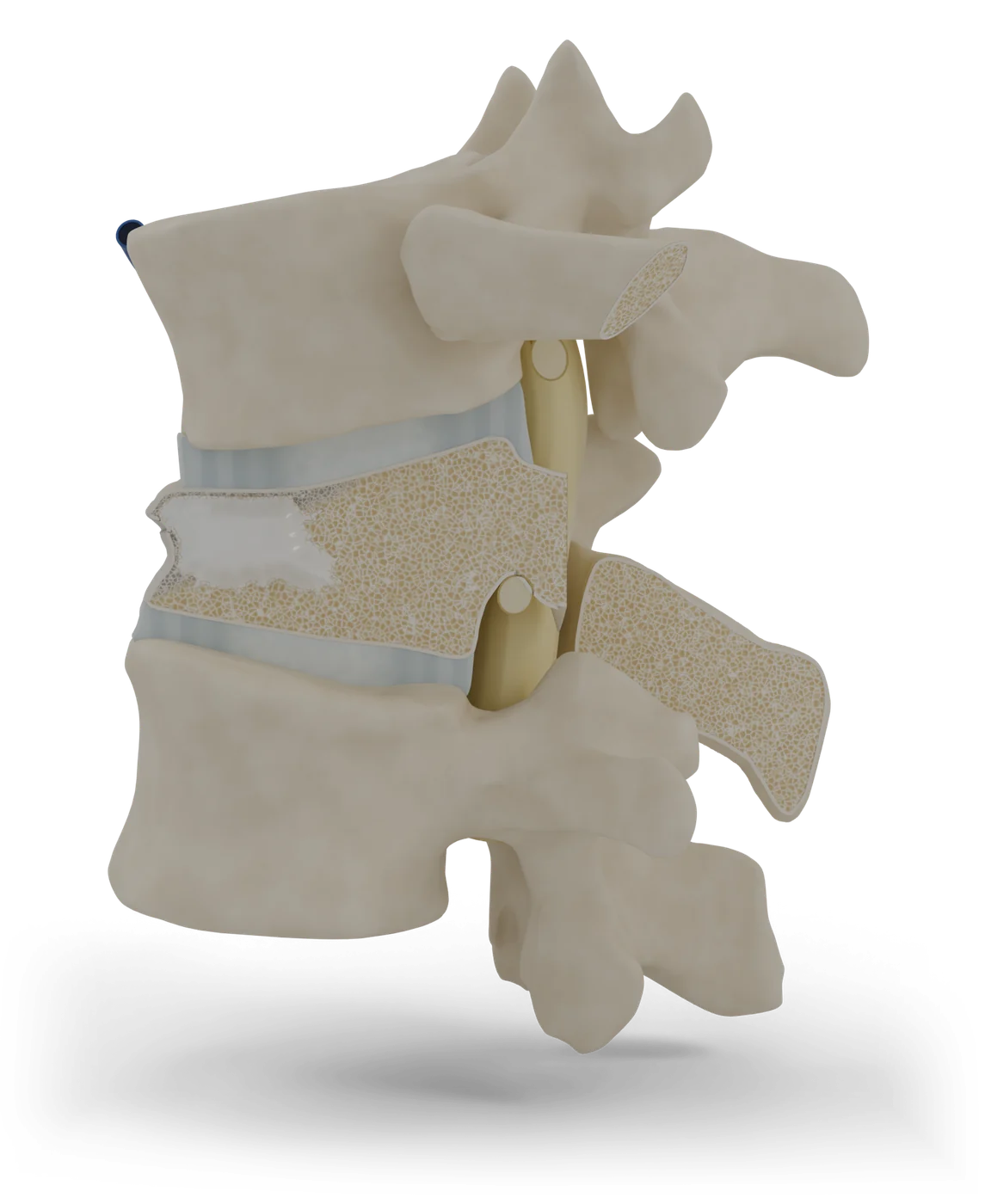 Vertebroplasty and kyphoplasty model, after treatment.