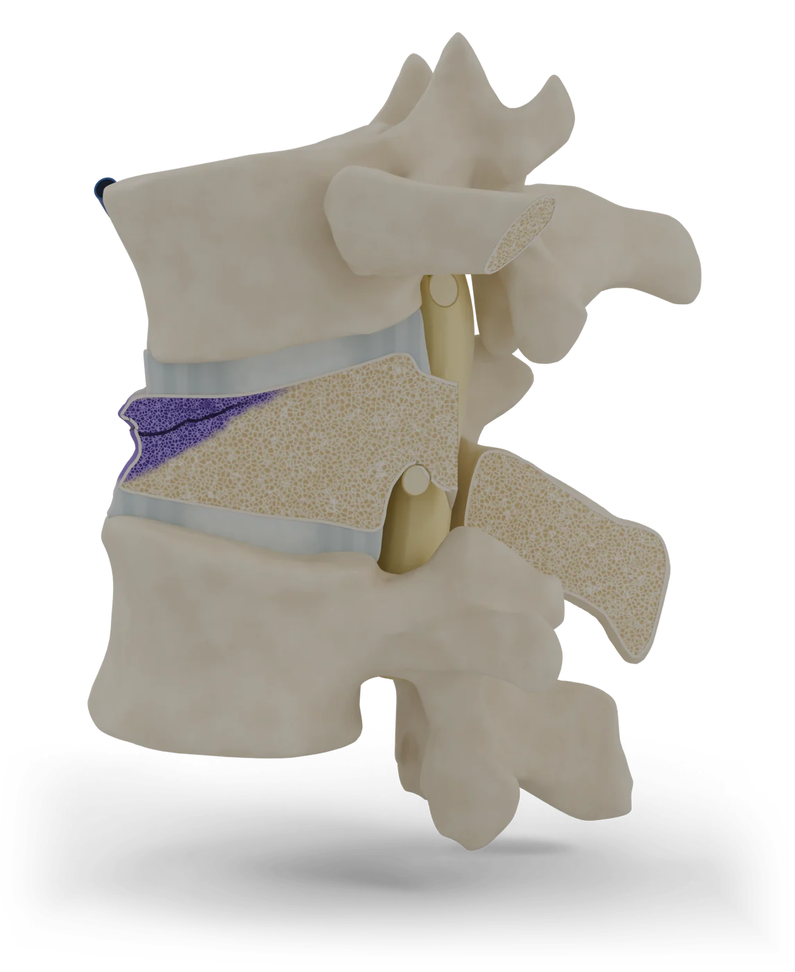 Vertebroplasty and kyphoplasty model, detail view.
