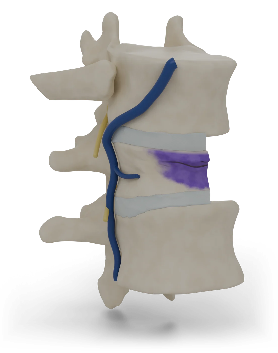 Vertebroplasty and kyphoplasty model, front view.