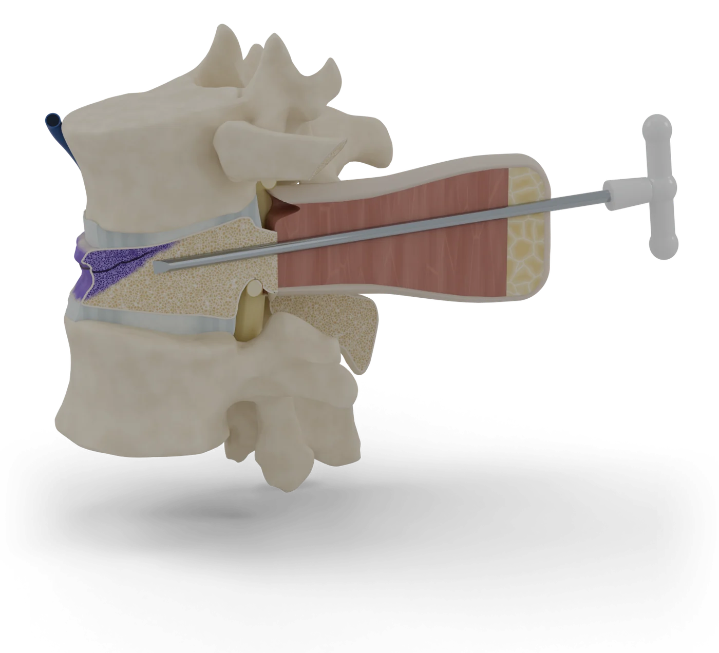 Vertebroplasty and kyphoplasty model, hero view.
